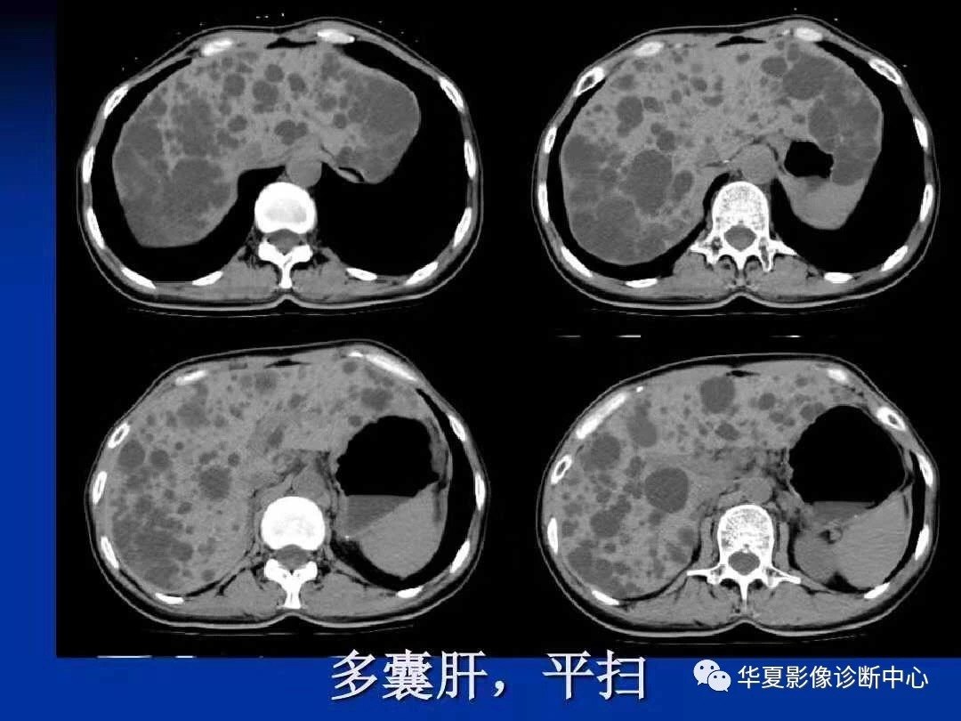 肝囊肿和多囊肝一样吗