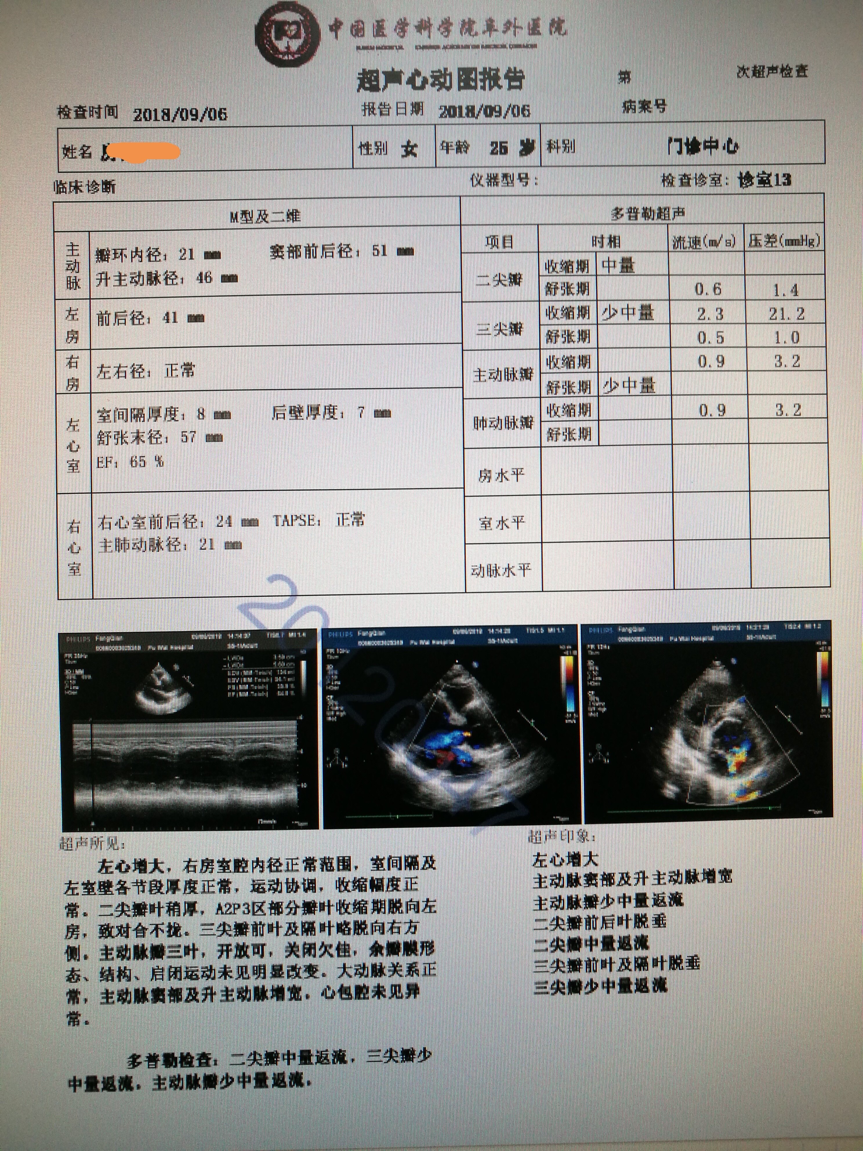 马凡氏综合症合并主动脉关闭不全二尖瓣关闭不全