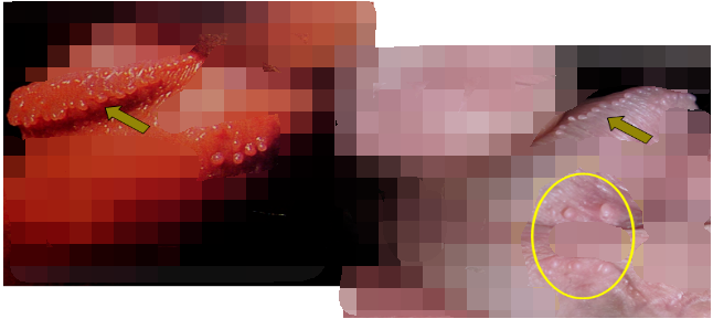 教你假性湿疣和尖锐湿疣的鉴别-图文并茂