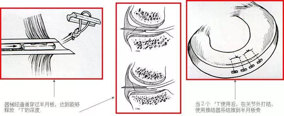 半月板缝合