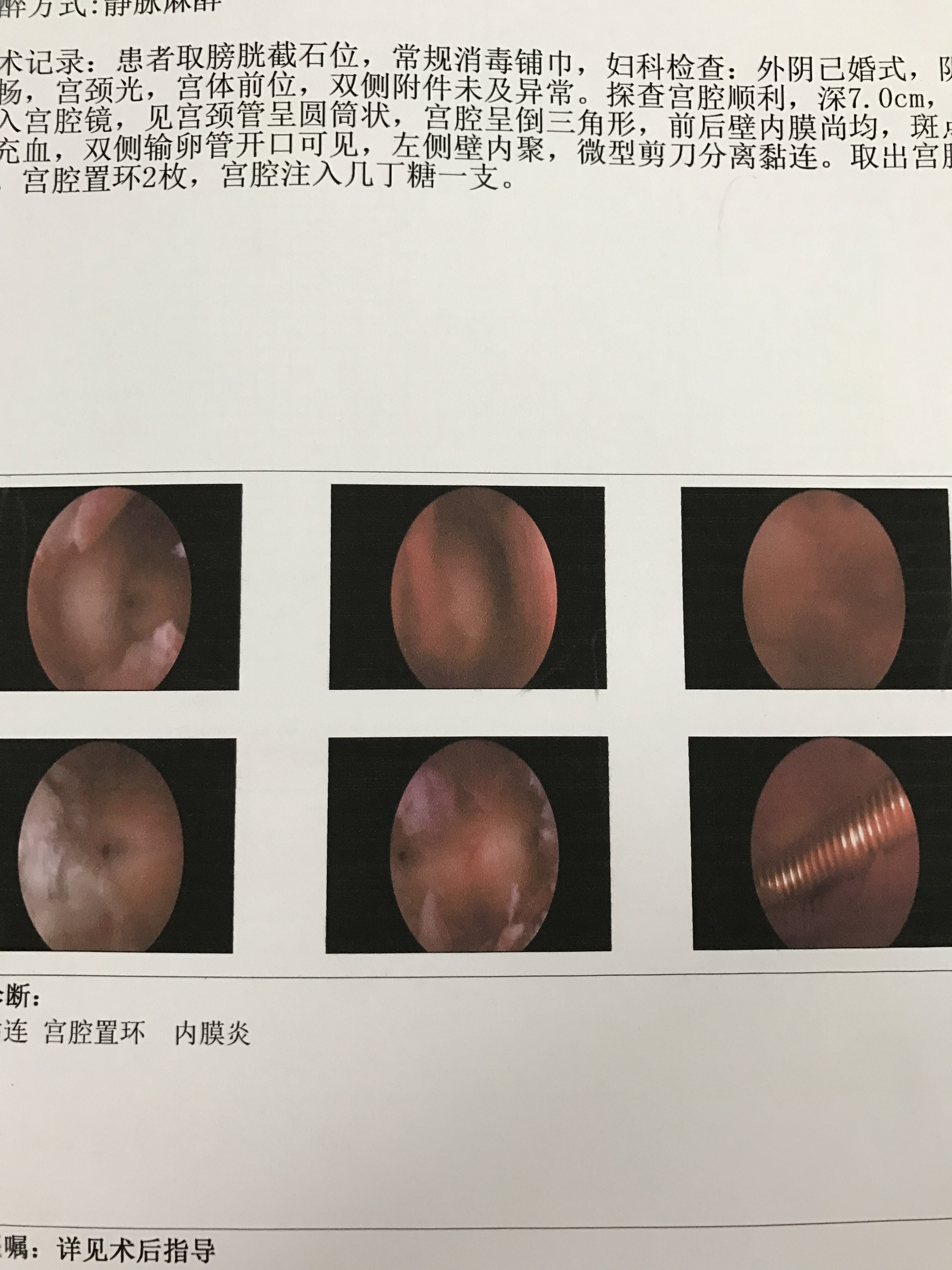 楼医生宫腔镜手术案例二