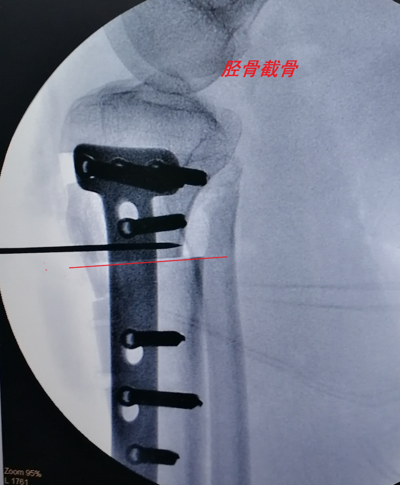 膝关节运动损伤科普之四:髌骨脱位治疗方案