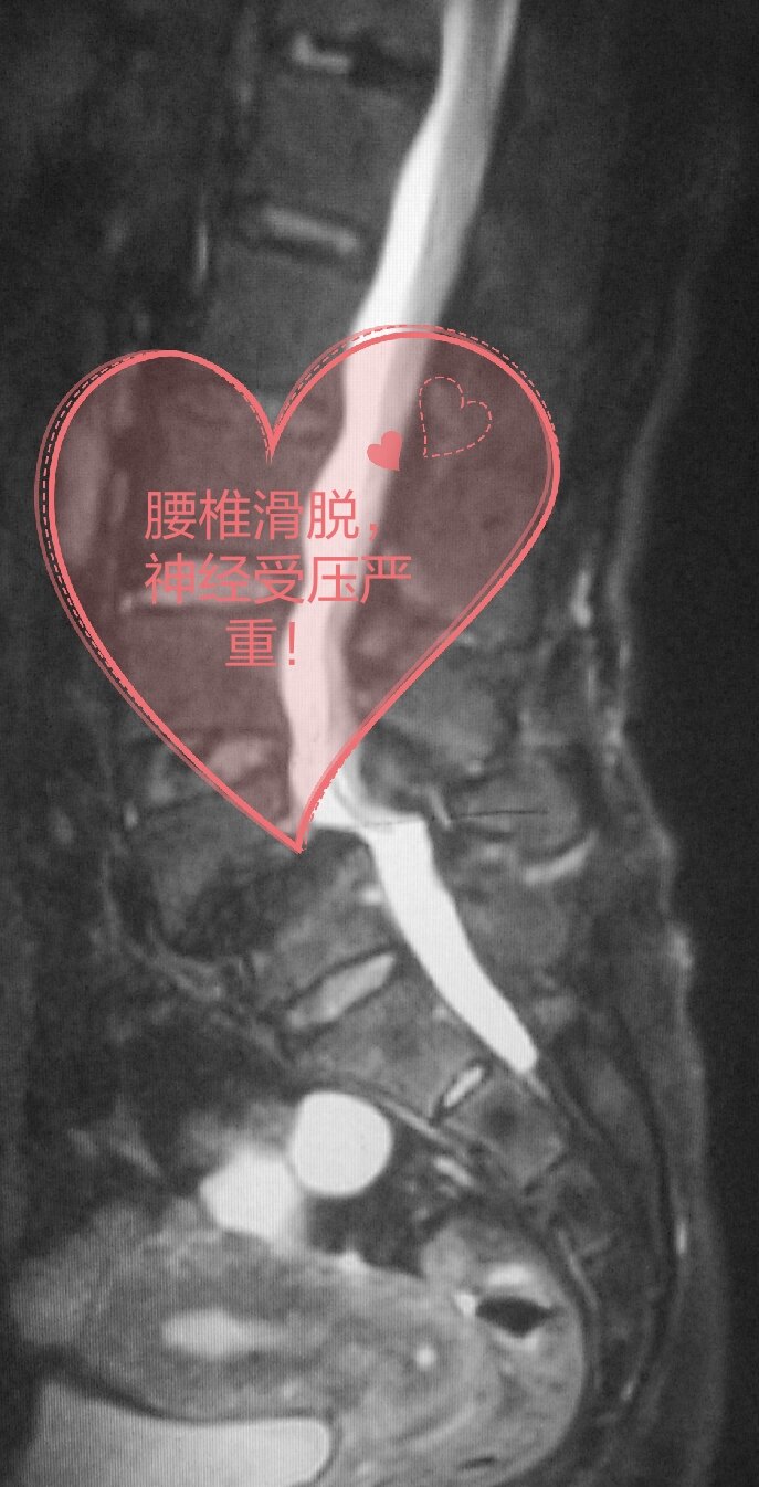 严重的腰椎滑脱成功复位神经压迫解除