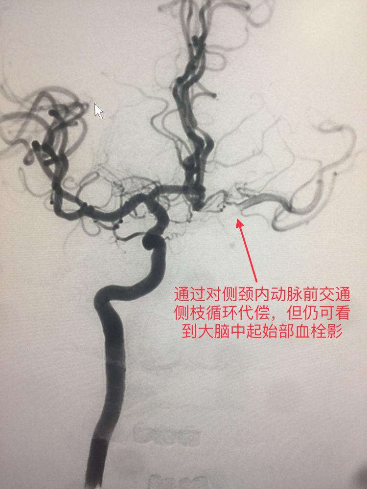 患者能表现正常全靠对侧颈内动脉的侧枝循环而代偿供血.