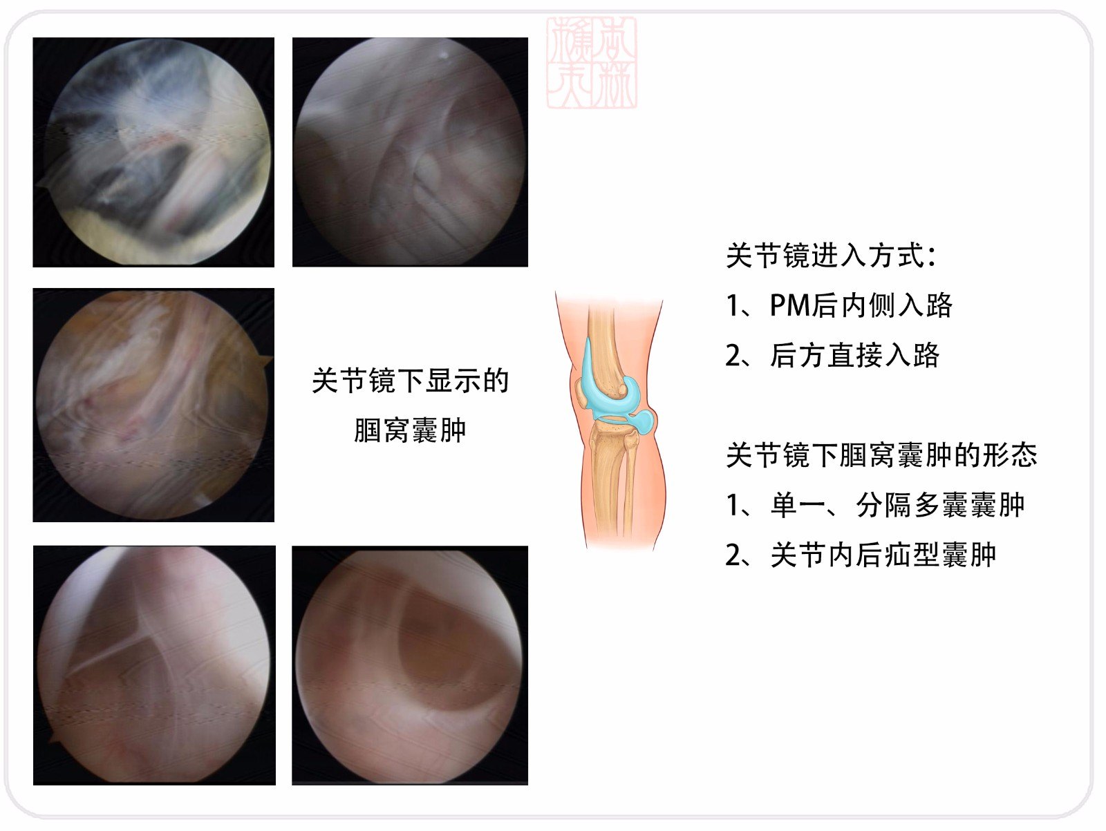 腘窝囊肿的微创治疗(含关节镜下手术录像)