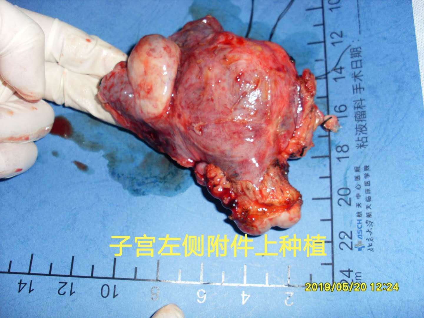 病例65--小阑尾大卵巢pmp早期病例