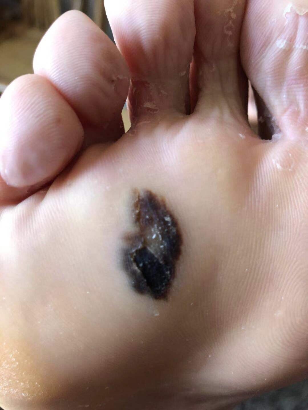 这是一位恶黑患者术前照片足底内侧的也是恶性黑色素瘤足大拇指恶性黑