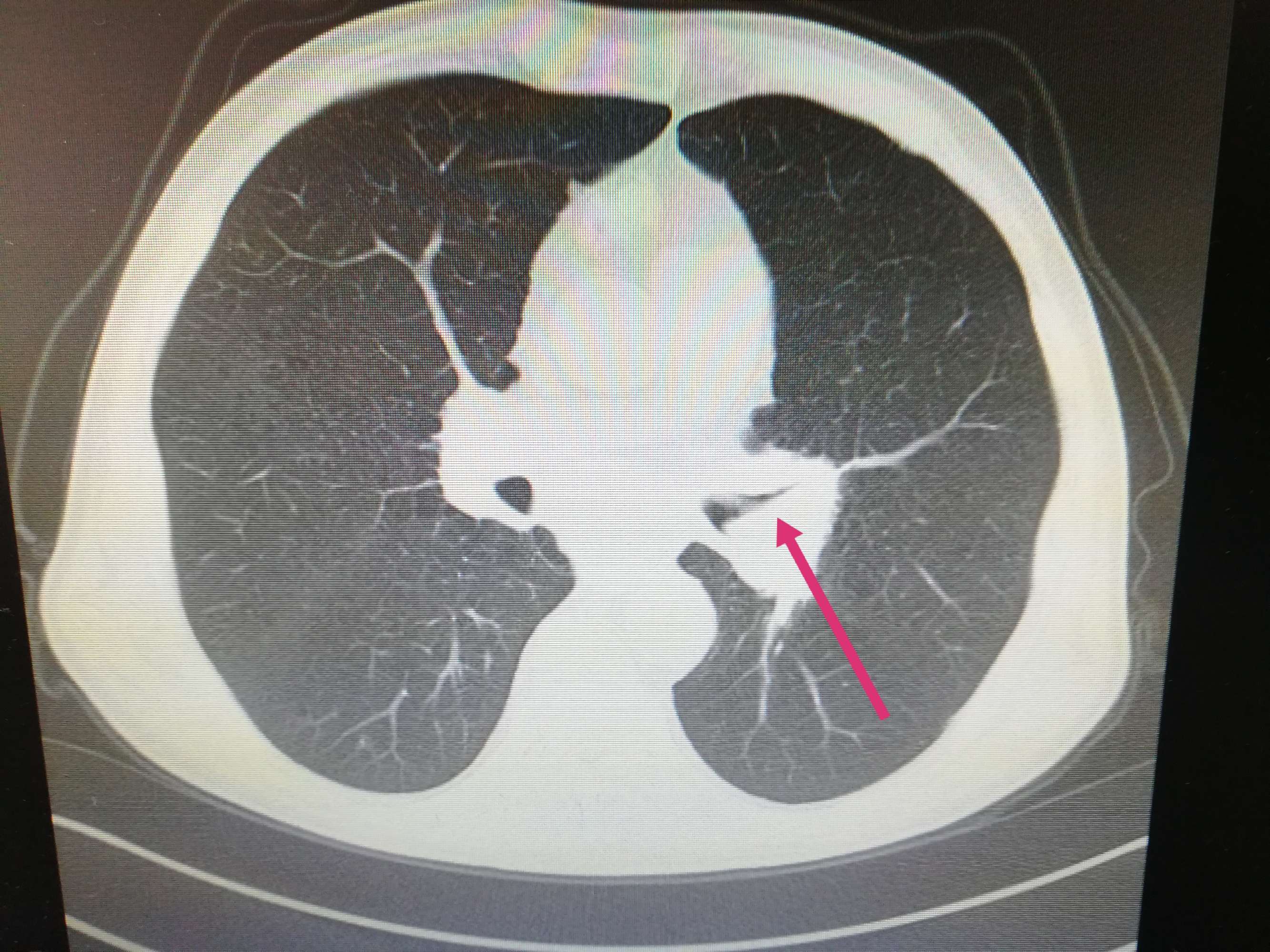 左侧肺门增大,支气管变细截断.