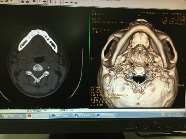 刘某,男,36岁,右侧颌下腺导管结石,ct片可见右侧口底前份,以及靠近