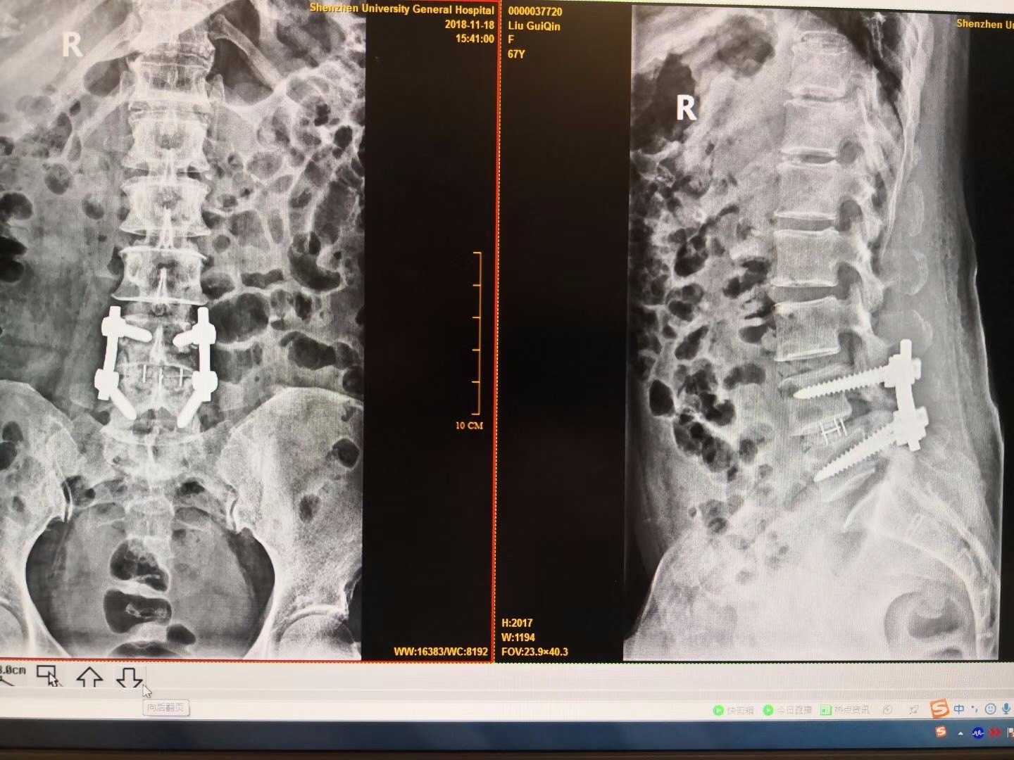 腰椎管狭窄椎体滑脱案例解析