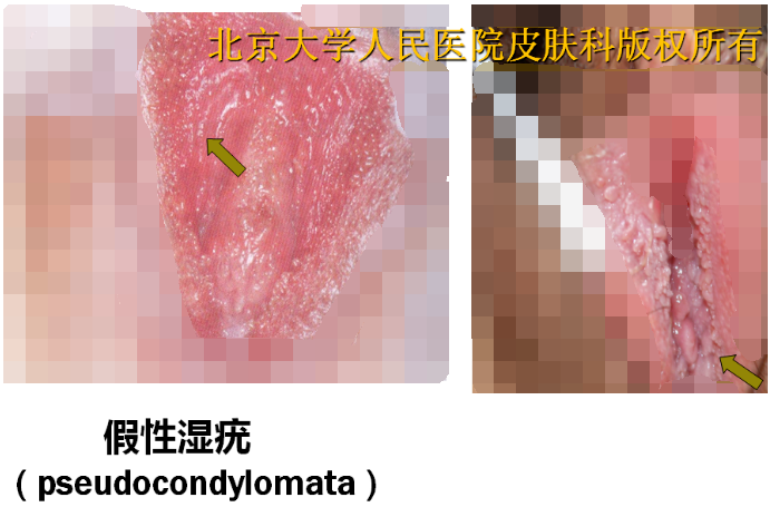 教你假性湿疣和尖锐湿疣的鉴别-图文并茂