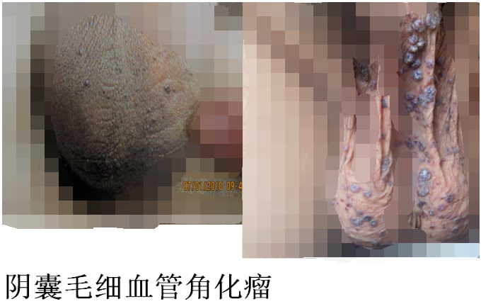 教你假性湿疣和尖锐湿疣的鉴别-图文并茂