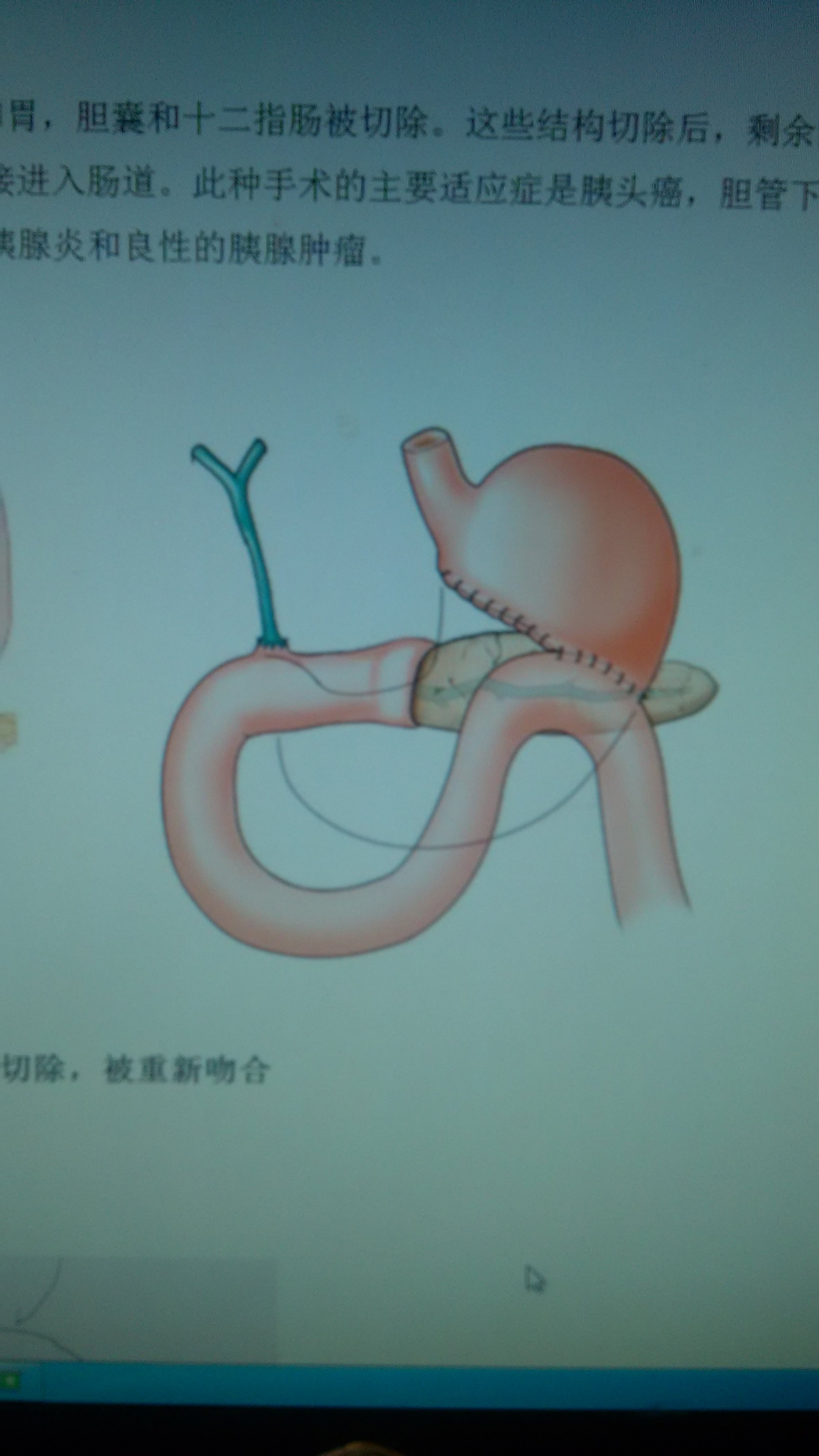 胃,胰腺,胆管疾病术后腹痛,发热,黄疸,警惕输入袢综合