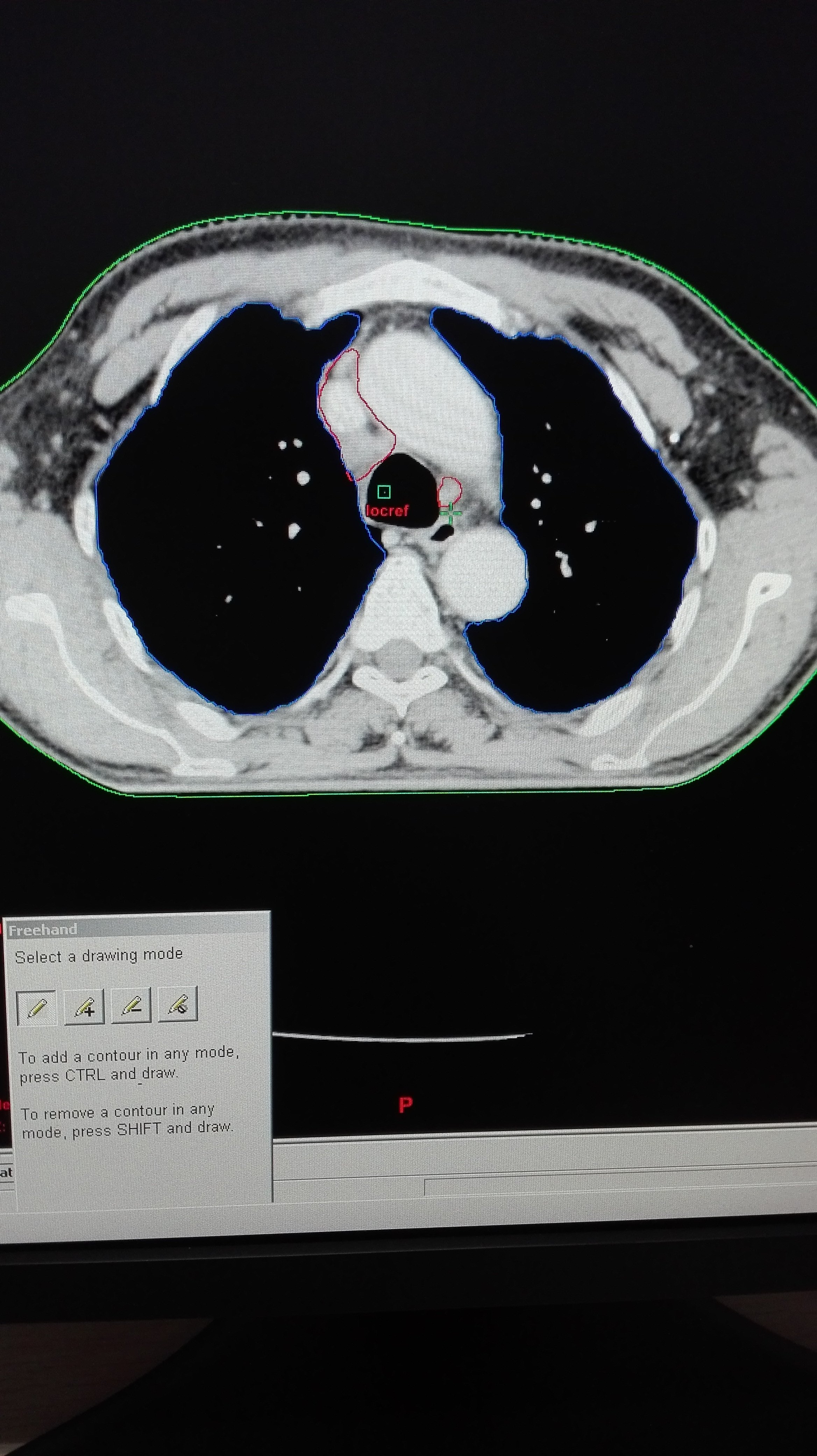 小细胞肺癌治疗的个案分享_好大夫在线