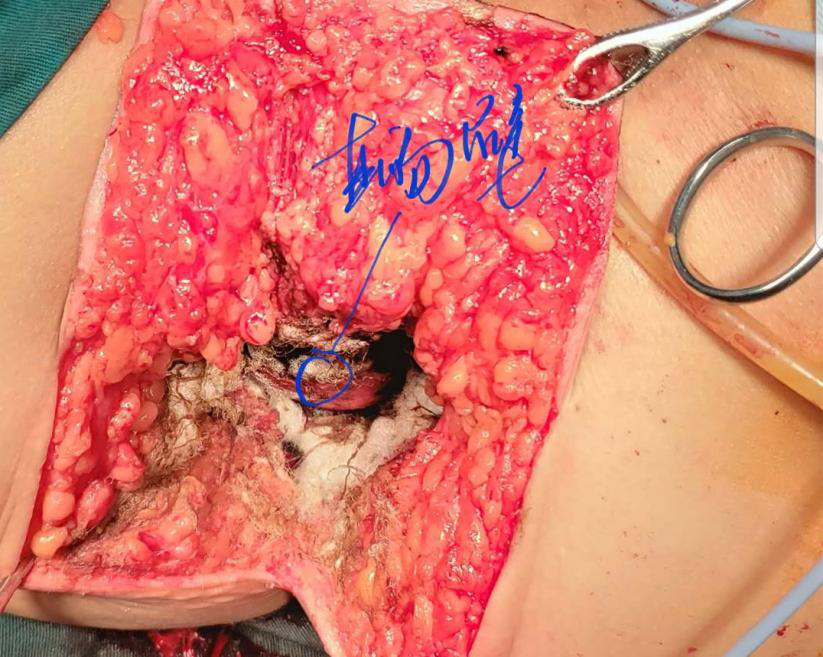 内蒙古患者骶前囊肿完整切除手术切口与体位的选择