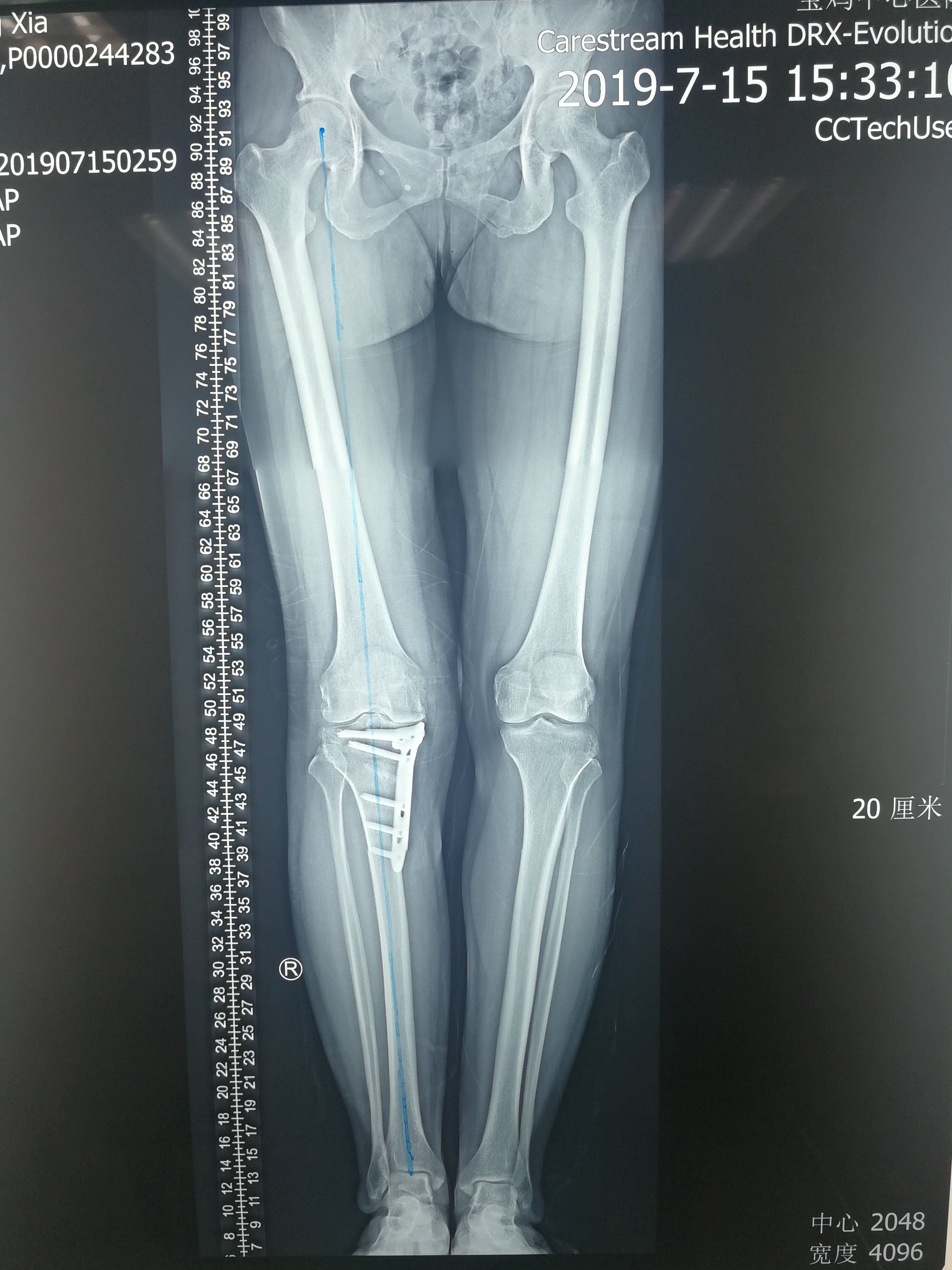 术后双下肢全长位片提示右胫骨高位截骨术后,下肢力线良好,内固定牢固