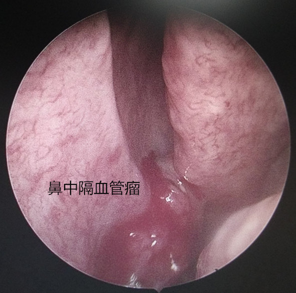 鼻腔血管瘤有哪些表现,怎么治疗?