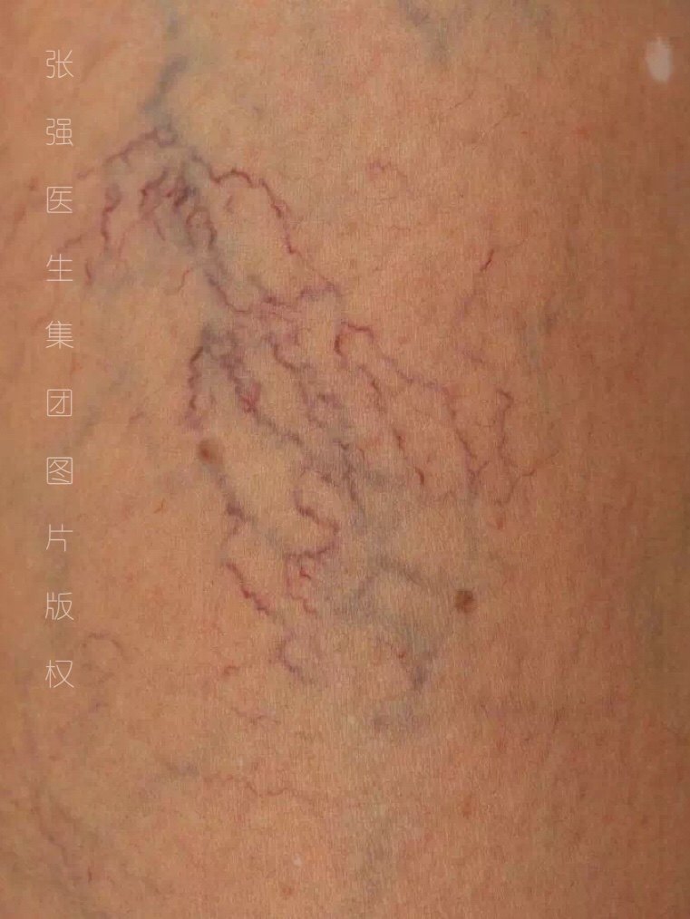 第一期:毛细血管扩张,此期人数最庞大,爱美的女士人心惶惶.