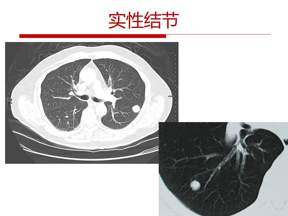 肺结节的ct筛查和处理策略