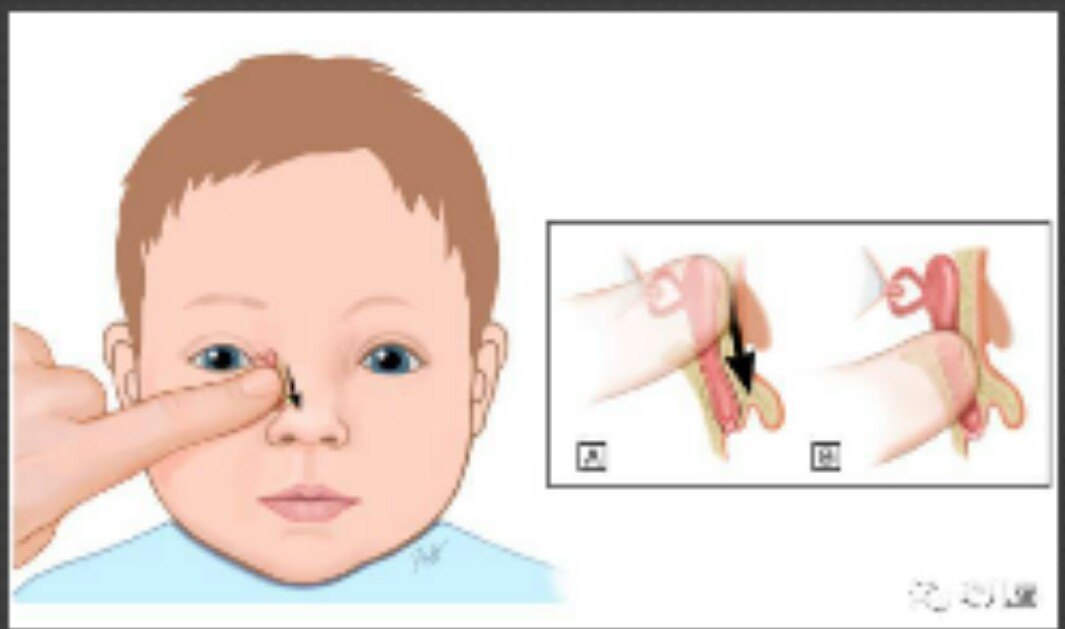 新生儿仰卧位,由另一人固定头部和四肢,操作者由鼻根部泪囊区顺鼻翼