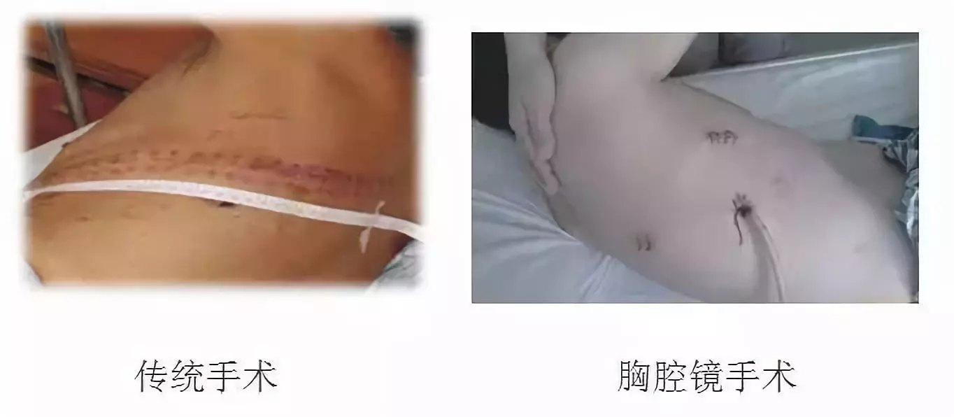 手术科普:肺癌,食管癌等胸腔镜微创手术