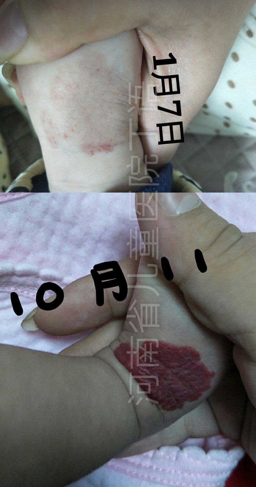 宝宝得了血管瘤,该怎么治疗