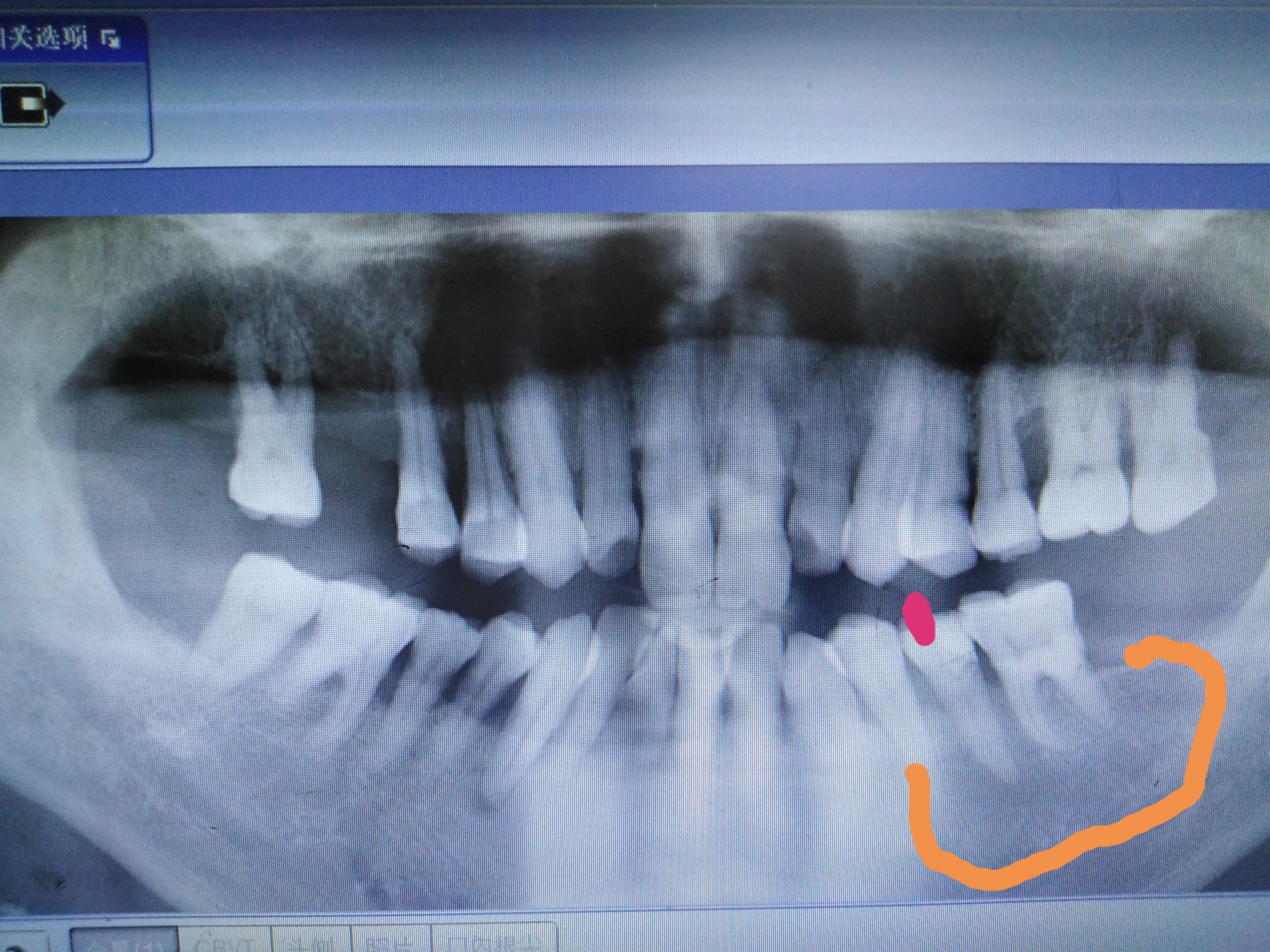 牙槽脓肿一例
