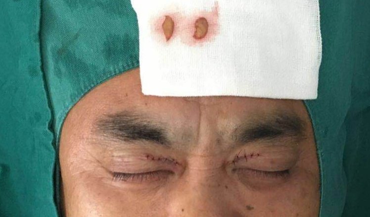 眼睑上长了一对恼人的小眼睛