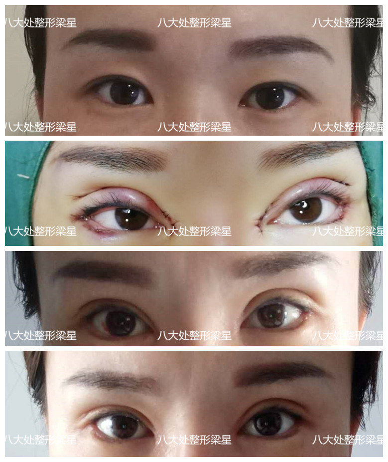 双眼皮要这么割,好看而且恢复快!