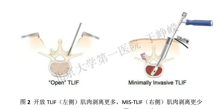 微创经椎间孔腰椎椎体间融合术mistlif