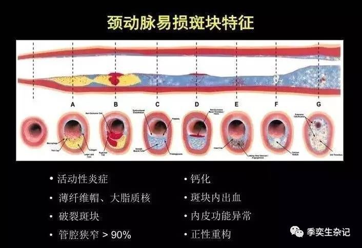 体检发现颈动脉斑块怎么办?