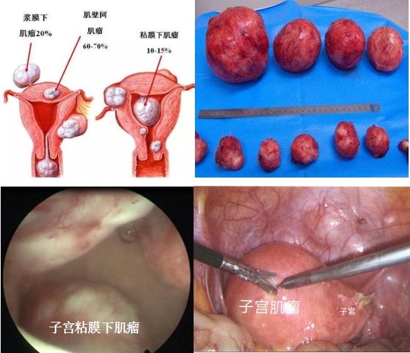 不孕的那些事儿(五)---子宫肌瘤