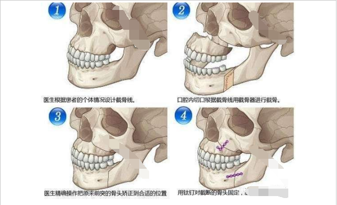 正颌手术术前准备