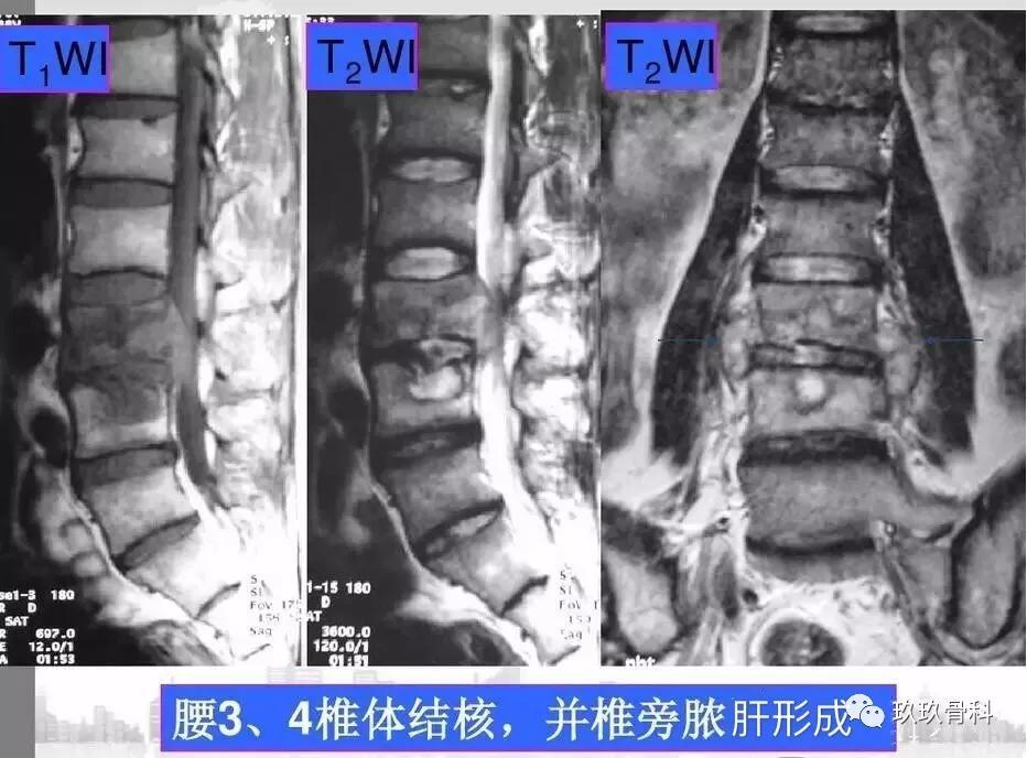 认识椎体终板炎转自玖玖骨科