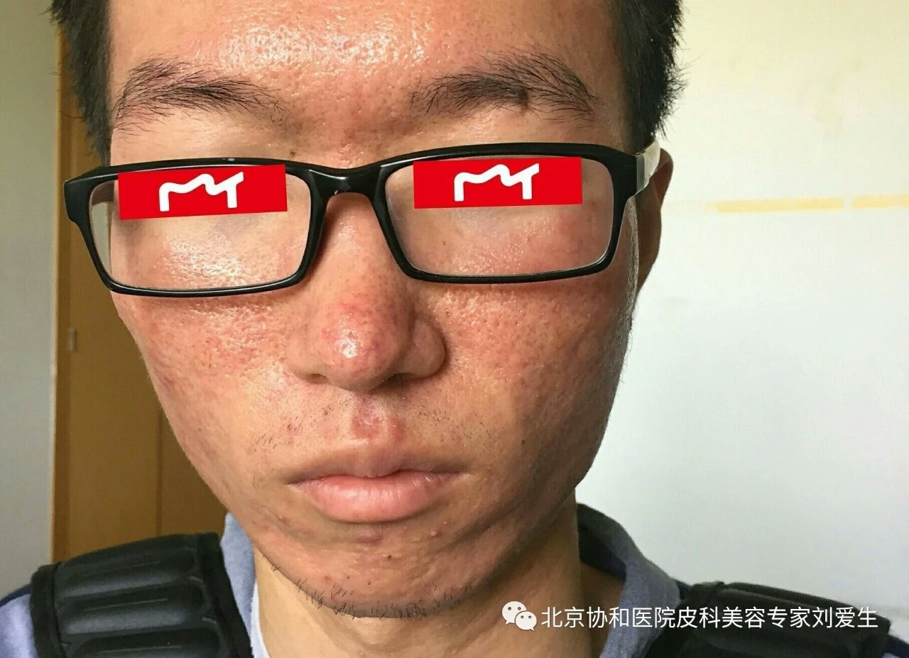 自诉:面部皮肤刺痛,烧灼,瘙痒,干燥,濒绷.