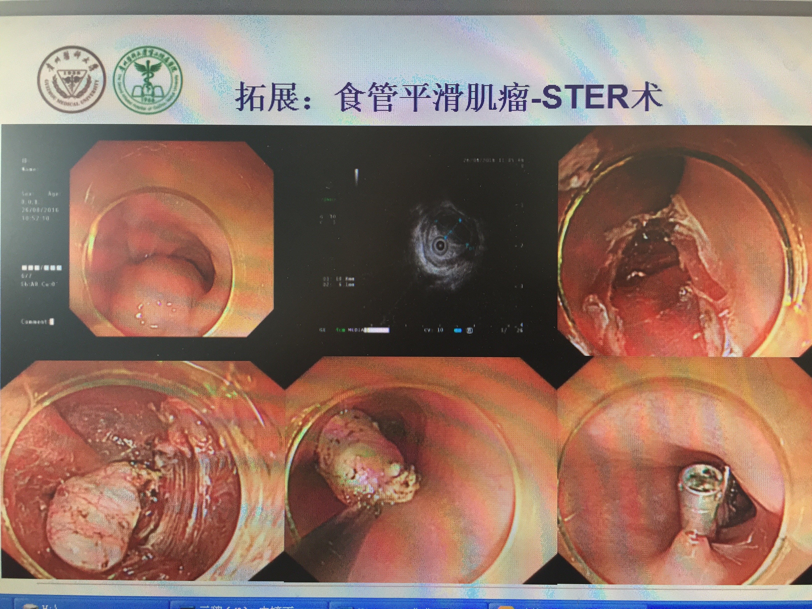 食管平滑肌瘤隧道技术切除