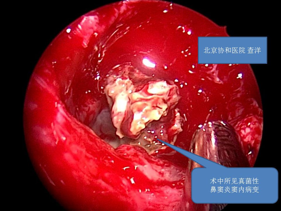 真菌性鼻窦炎患者手术常见问题及注意事项