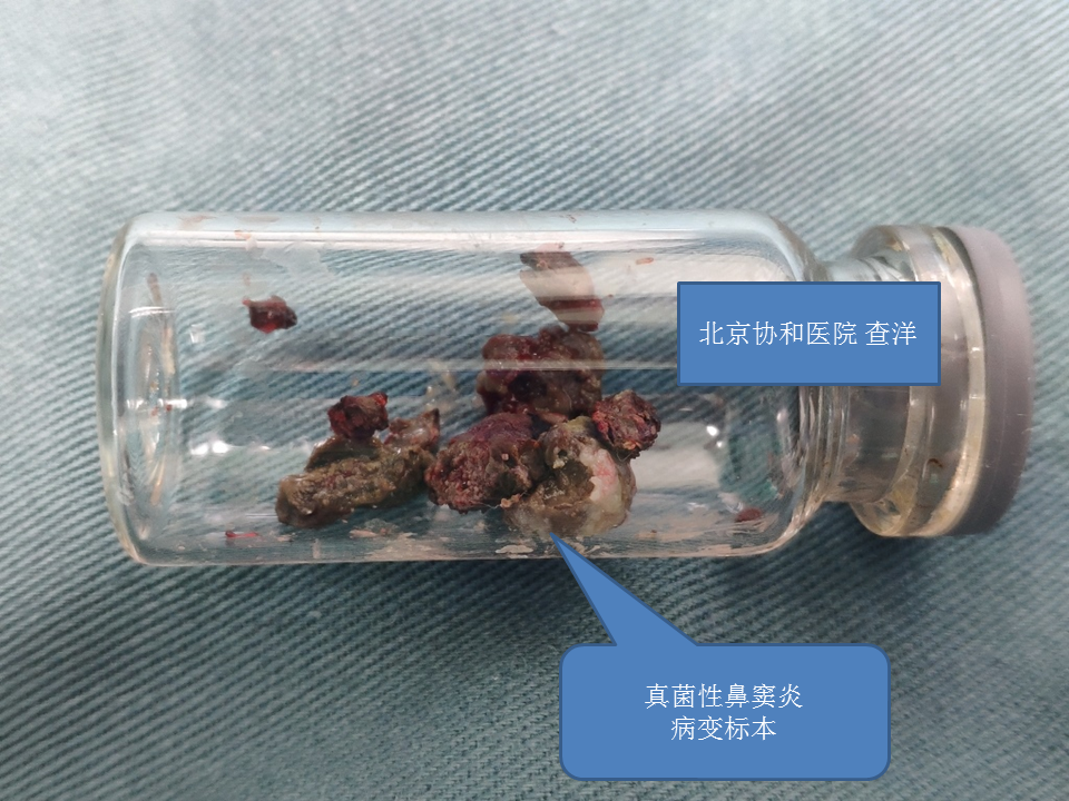 真菌性鼻窦炎患者手术常见问题及注意事项