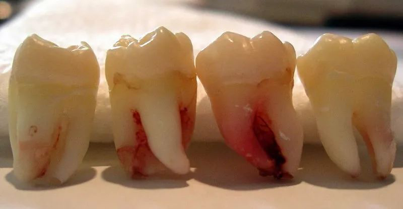 左上a是理想的移植牙牙根形态;b接近理想;c长度不足;d前磨牙牙根形态