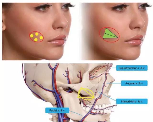 玻尿酸的正确注射方法和解析(中面部篇)  三,鼻部衰老的变化  鼻子是