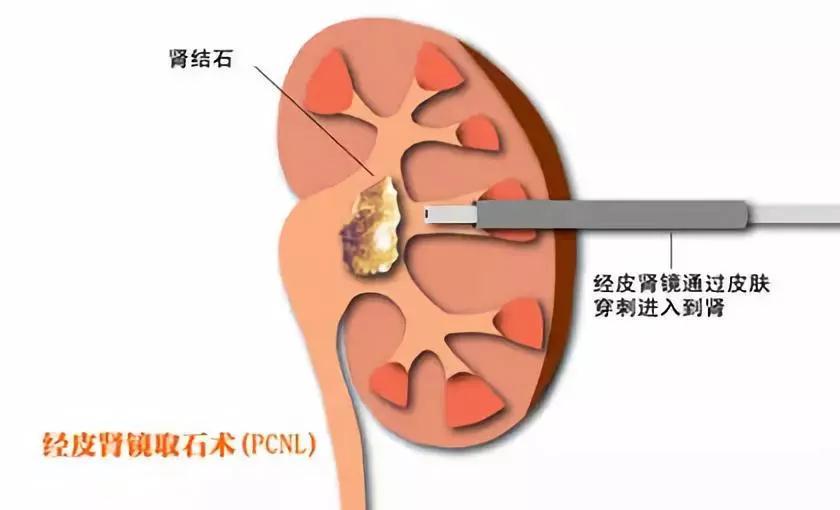 患了肾结石该如何治疗?