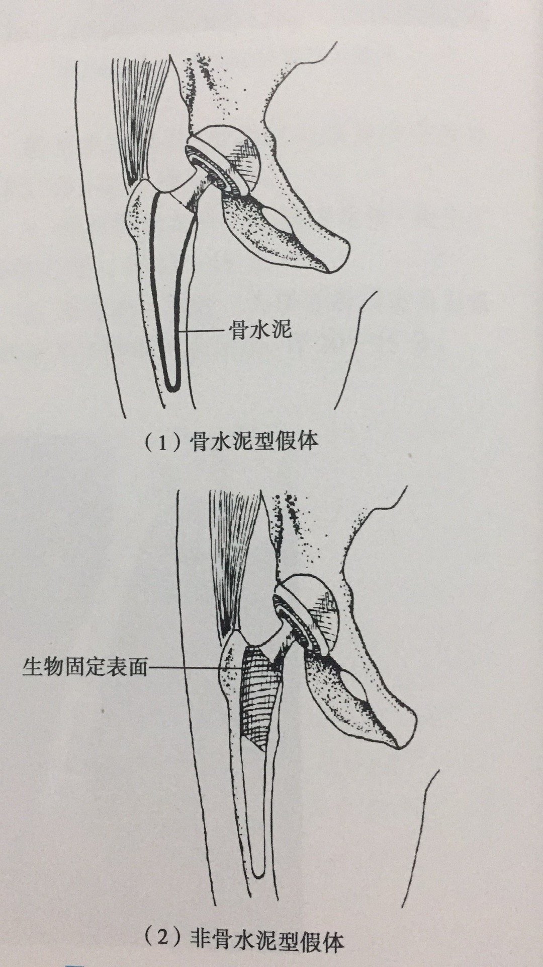 髋关节置换术后早期康复