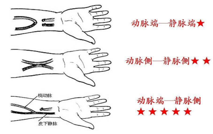 自体动静脉内瘘到底该如何护理呢?