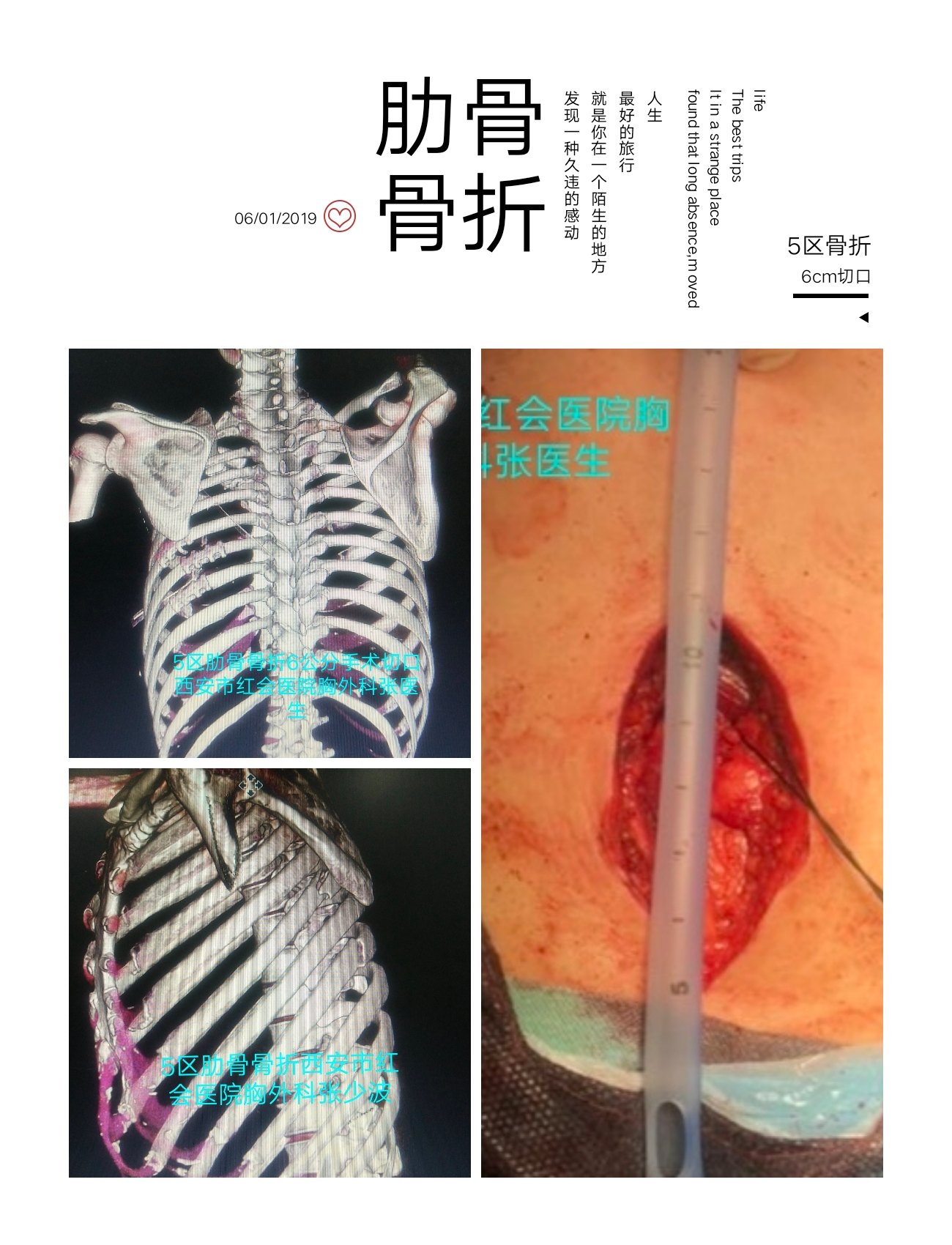 肋骨骨折手术没有对比就没有伤害