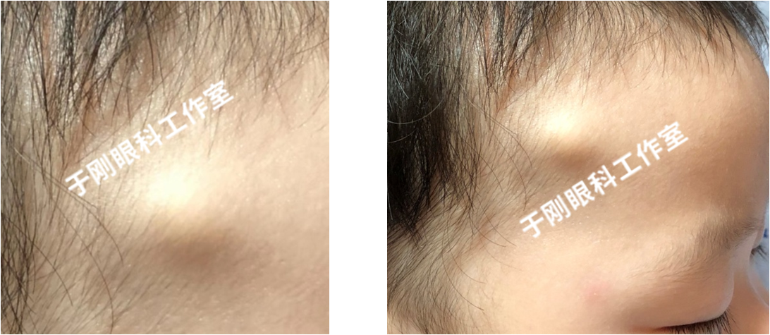 儿童眼眶皮样囊肿如何手术附照片