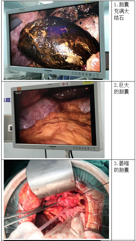 胆囊结石和胆囊炎,并不是您想象的样子