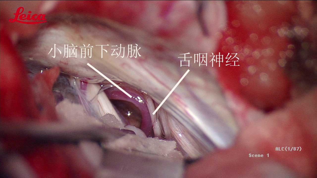 术前多模态融合帮助一例舌咽神经痛病人缓解痛苦