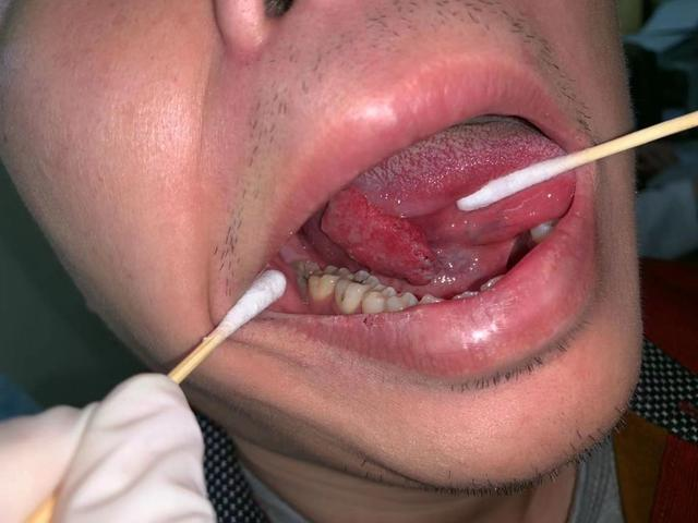 为他进行了详细的检查,发现长在舌头下的肿物已经很大了,且病例结果
