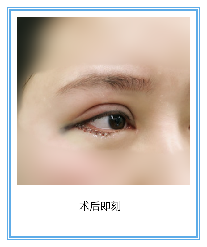 比如,会有睑球分离的情况发生,另一疙蚍掷外眼角韧带外眦韧带眼球
