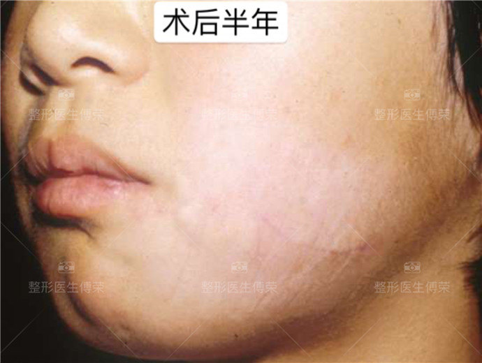 【疤痕修复案例分享】